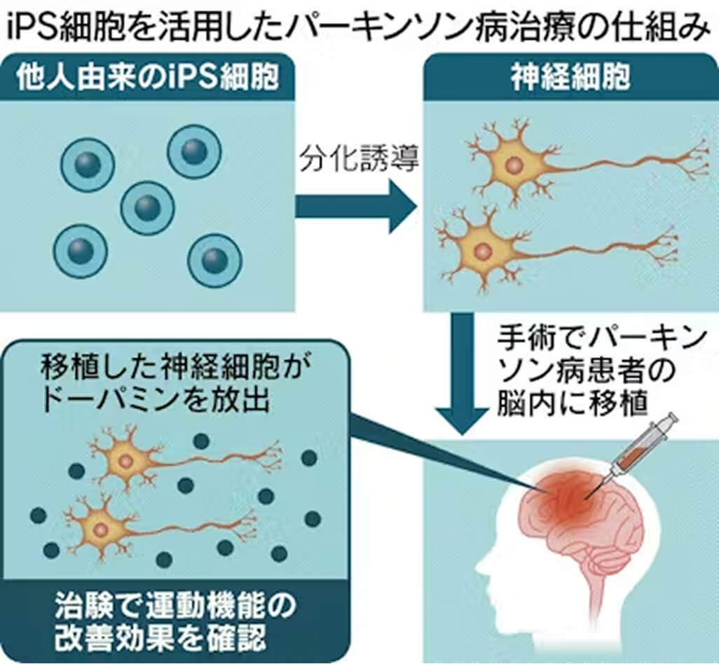 iPS細胞を活用したパーキンソン病治療の仕組み