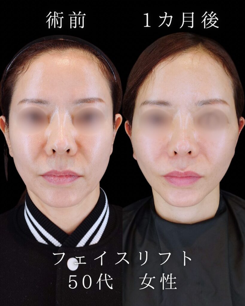 フェイスリフト 症例 ビフォーアフター