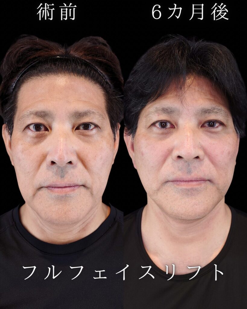 フェイスリフト 症例 ビフォーアフター