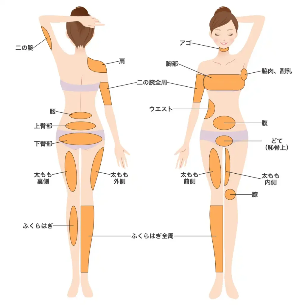 脂肪吸引が可能な部位：二の腕・肩・腰・臀部・太もも・ふくらはぎ・ウエスト・腹・胸部・脇肉など