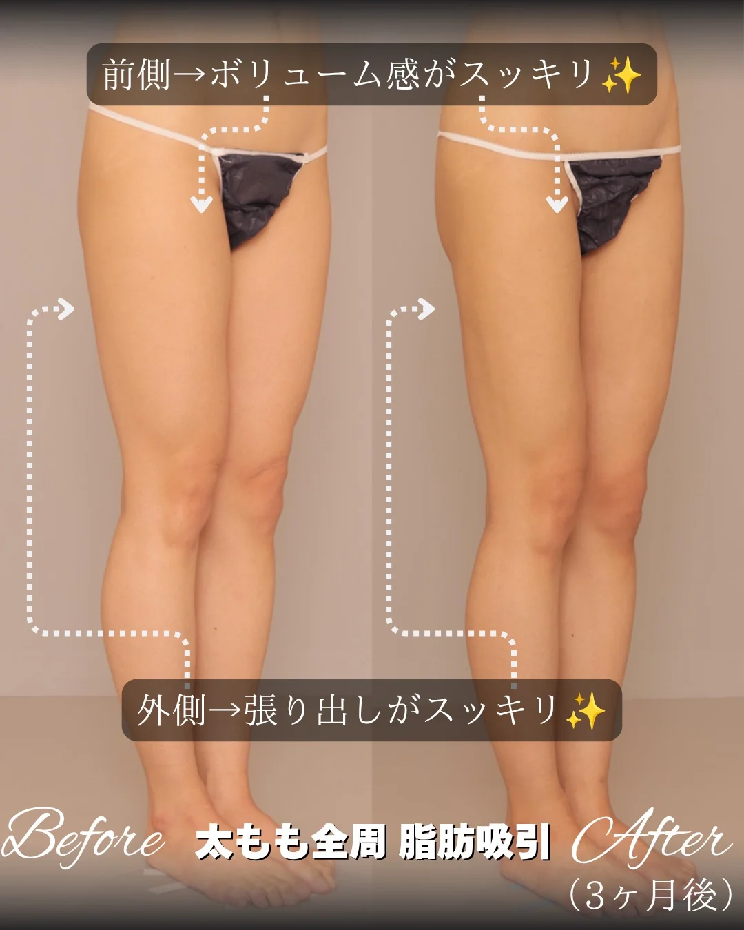 太もも全周の脂肪吸引 施術前と術後3ヶ月の比較（斜め）