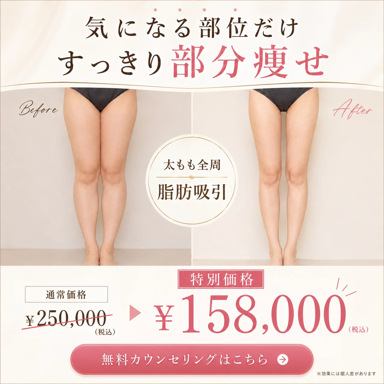 気になる部位だけすっきり部分痩せ 太もも全周 脂肪吸引 通常価格250,000円（税込）→特別価格158,000円（税込）無料カウンセリング受付中